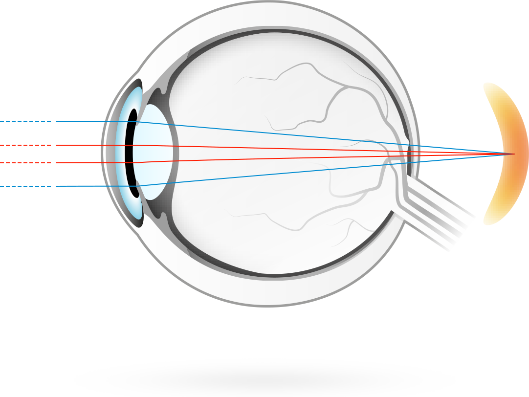 Übersichtigkeit - häufig auch Weitsichtigkeit genannt - Die Strahlen des Lichts bündeln sich erst hinter der Netzhaut. Dies macht es für das Auge schwieriger, Objekte in der Nähe scharf zu sehen - unscharfe Sicht in der Nähe. Übrigens: je nach Grad der Übersichtigkeit und Lebensalter kann diese Unschärfe durch Anstrengung der Augenlinse ausgeglichen werden.