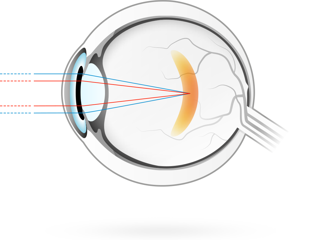 Kurzsichtigkeit - Aus der Ferne einfallende Lichtstrahlen werden vor der Netzhaut gebündelt und ergeben so ein unscharfes Bild - unscharfe Sicht in der Ferne.