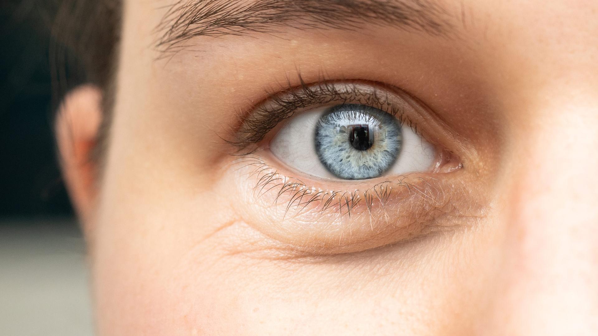 Yeux gonflés, cernés ; rougeur et sensation de brûlure oculaires