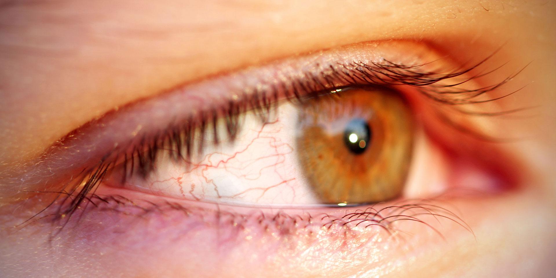 Yeux rouges et douloureux