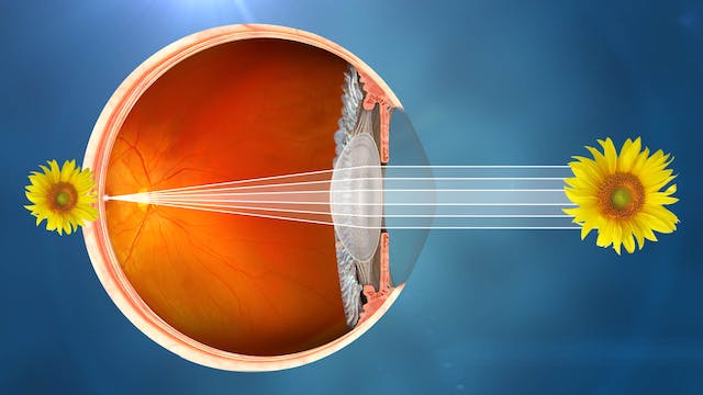 Qu'est-ce que la cataracte - Santé oculaire