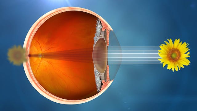 Qu'est-ce que la cataracte - Vision altérée par une cataracte
