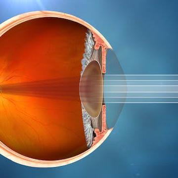 Qu'est-ce que la cataracte - Vision altérée par une cataracte
